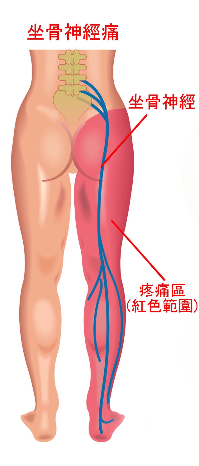 坐骨神經痛