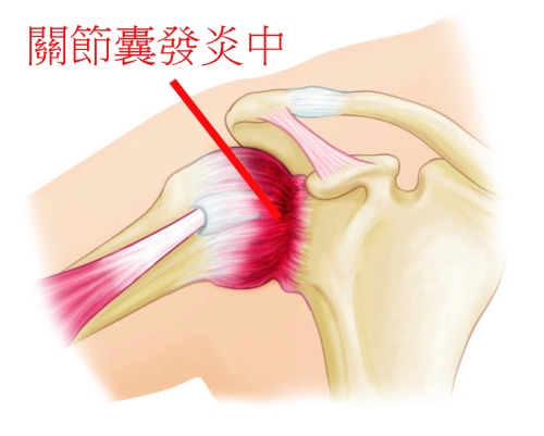 肩周炎物理治療五十肩.jpg 