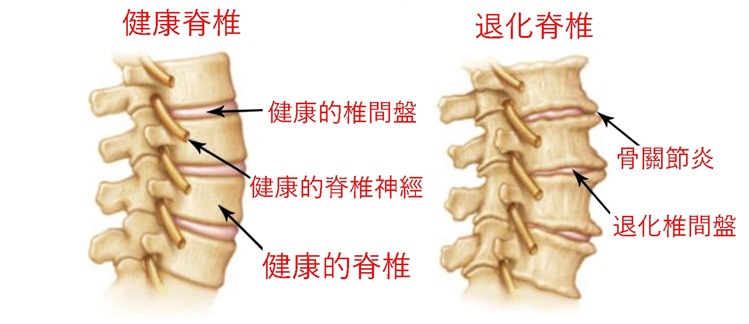 脊椎退化