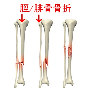 脛骨及腓骨骨折