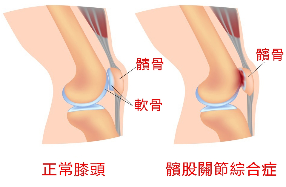 臏股關節綜合症 - 成因