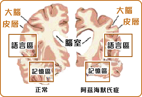 大腦內會出現病變