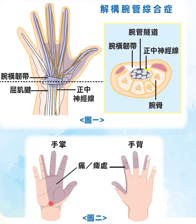 認識腕管綜合症