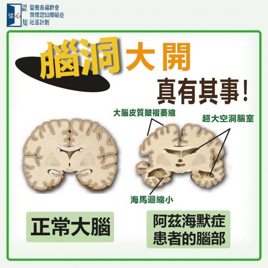 「腦洞大開」是網絡用語，形容人有超凡想像力；但也確切描述了患上阿茲海默症 （即認知障礙症的其中一種）人士的腦部情況。
阿茲海默症指患者的腦部積聚「澱粉狀蛋白斑塊」(amyloid) ，引致腦細胞逐漸死...