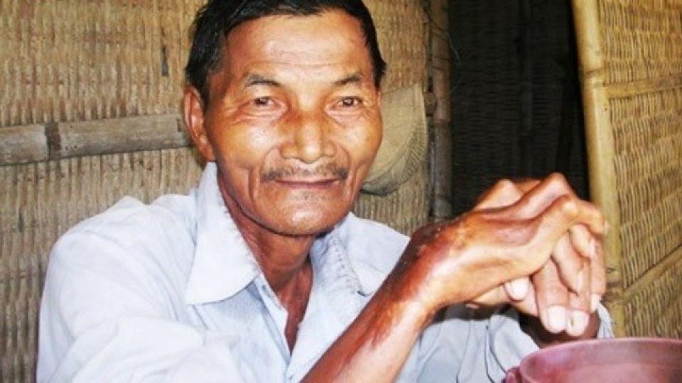 據説這名越南農民50年
前發病高燒之後,就再
也無法真正睡眠,就算
食安眠藥,或被灌醉,
等等方法也無法睡覺
但身體基本沒有問題... 據説這名越南農民50年
前發病高燒之後,就再
也無法真正睡眠,就算
食安眠藥,或被灌醉,
等等方法也無法睡覺
但身體基本沒有問題...