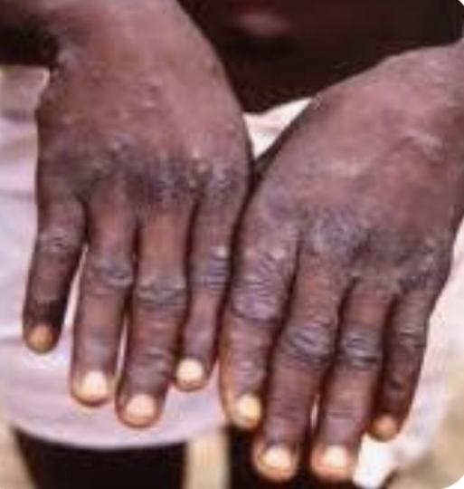 猴痘

「猴痘」流行於中西非國家。初期症狀如感冒，發燒後全身會出疹子，如果感染的是剛果病毒株，致死率10%, 猴痘傳染來源是齧齒類動物如老鼠，人類被咬後感染，再藉由飛沫和體液傳染給他人。...