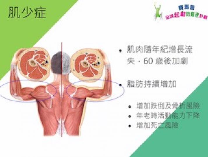 肌少症

老友記要留意自己是否患上肌少症，以確保健康。
肌少症跟骨質疏鬆一樣，是老年人很容易面臨到的疾病，造成的死亡風險並不是只有來自於肌肉無力的「跌倒」，肌少症還會因為肌肉質量下降，導致的老化細胞增...