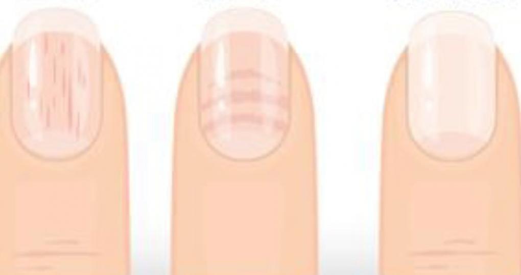 健康的指甲
健康的指甲底色應呈現紅潤的粉紅色、表面有光澤，厚度均勻且壓起來有彈性、不易斷裂，表面沒有龜裂、凹洞或者特殊顏色的紋路，壓其前端，放開後血色立即恢復，表示血液循環良好。如果指甲有異狀要小心，...