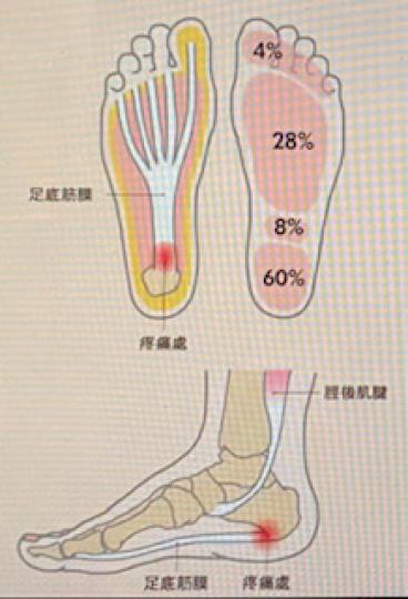 足底筋膜炎
大家要注意足底筋膜炎的位置和足部重量的分布以我防患足底筋膜炎。...