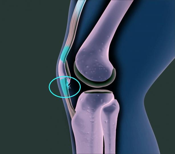 膝痛之臏骨腱炎及脂肪體綜合症 Patellar Tendinitis & Fat Pad Syndrome【傷患痛症系列】