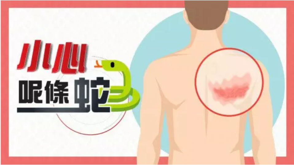 【生蛇冷知識】病原早在兒時種下?長滿一圈會致命是真的嗎? 【生蛇冷知識】病原早在兒時種下?長滿一圈會致命是真的嗎?
