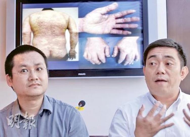 牛皮癬患者黎先生(左)和傅先生(右)表示,用生物製劑後病况明顯改善。黎先生指藥物昂貴,不得不停用。(李紹昌攝) 牛皮癬患者黎先生(左)和傅先生(右)表示,用生物製劑後病况明顯改善。黎先生指藥物昂貴,不得不停用。(李紹昌攝)