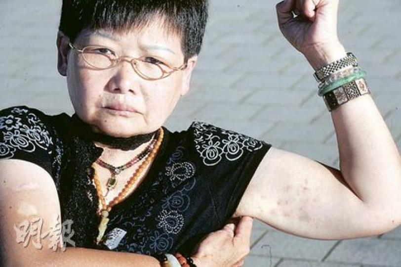 59歲的「金蟬婆婆」麥潔玲於7月2日凌晨政府總部清場時，因阻擋警察拘捕年輕人而成為社運友的新偶像，近日紅遍facebook。她與警察糾纏留下的手臂瘀痕未退，成為她抗爭強權的印記。（尹錦恩攝）