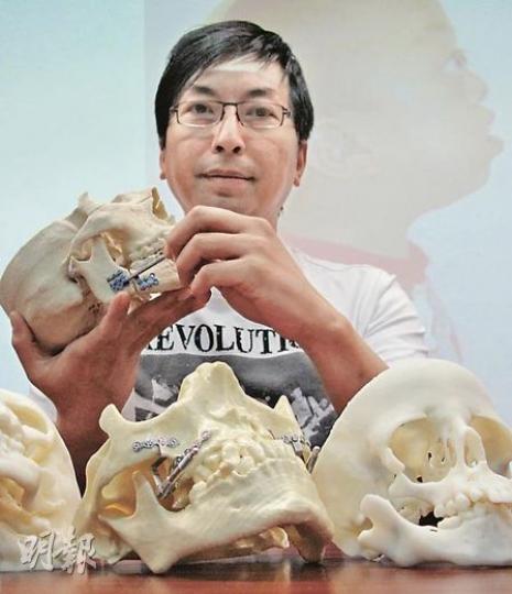 手持自己口腔模型的李先生,下顎粉碎後曾在牙骱嵌入鐵片,事後出現睡眠窒息,「牽引成骨術」成功把他下顎向前移動數十毫米,外表上分別不大,但睡眠質素卻有天淵之別。(曾愛盈攝)「牽引成骨手術」會在病人下顎的牙骱位置植入牽引器,病人每天自行把支架左右的轉盤轉兩圈,便可把下顎骨向推前1毫米,待3個月後骨骼定形後,便可動手術把牽引器取出。(曾愛盈攝) 手持自己口腔模型的李先生,下顎粉碎後曾在牙骱嵌入鐵片,事後出現睡眠窒息,「牽引成骨術」成功把他下顎向前移動數十毫米,外表上分別不大,但睡眠質素卻有天淵之別。(曾愛盈攝)「牽引成骨手術」會在病人下顎的牙骱位置植入牽引器,病人每天自行把支架左右的轉盤轉兩圈,便可把下顎骨向推前1毫米,待3個月後骨骼定形後,便可動手術把牽引器取出。(曾愛盈攝)
