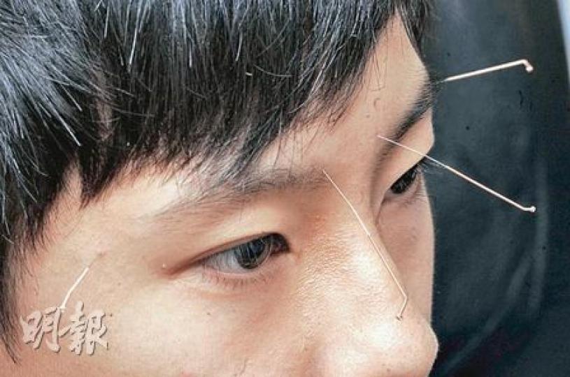 有份參與研究的中大眼科及視覺科學系中醫師趙建浩指出,是次針灸治弱視研究所選取的5個穴位,大多是針對眼病,也考慮到安全。圖中接近眉頭的為攢竹穴,眼尾後的是太陽穴,此兩穴要左右同時施針。(朱永倫攝) 有份參與研究的中大眼科及視覺科學系中醫師趙建浩指出,是次針灸治弱視研究所選取的5個穴位,大多是針對眼病,也考慮到安全。圖中接近眉頭的為攢竹穴,眼尾後的是太陽穴,此兩穴要左右同時施針。(朱永倫攝)
