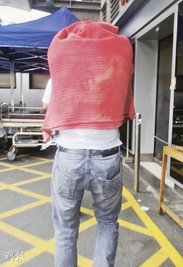 男子拔罐時背部被灼傷,送院時患處敷上防感染膜。(蔡方山攝) 男子拔罐時背部被灼傷,送院時患處敷上防感染膜。(蔡方山攝)