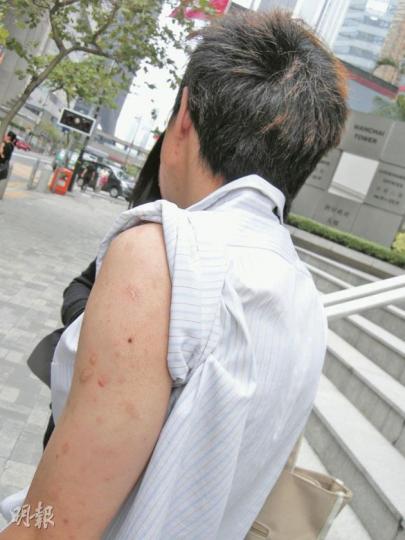 事主向記者顯示傷痕,他臂上滿是被煙蒂灼傷的疤痕。(吳光熙攝) 事主向記者顯示傷痕,他臂上滿是被煙蒂灼傷的疤痕。(吳光熙攝)