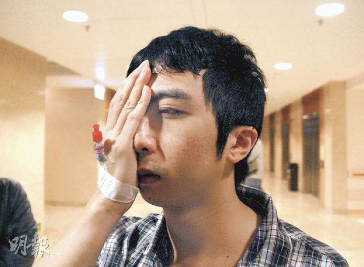 投訴醫生醫療失誤導致左眼幾近失明的劉姓事主,蓋着健全的右眼,向記者形容單靠左眼只見到模糊影像。(雲錦鋒攝) 28歲男子劉海倫由於患有甲狀腺亢進症,在醫院接受「眼腔減壓手術」後,發現左眼視力幾近全失,他亦擔心無力照顧兩歲幼子。(雲錦鋒攝) 投訴醫生醫療失誤導致左眼幾近失明的劉姓事主,蓋着健全的右眼,向記者形容單靠左眼只見到模糊影像。(雲錦鋒攝) 28歲男子劉海倫由於患有甲狀腺亢進症,在醫院接受「眼腔減壓手術」後,發現左眼視力幾近全失,他亦擔心無力照顧兩歲幼子。(雲錦鋒攝)