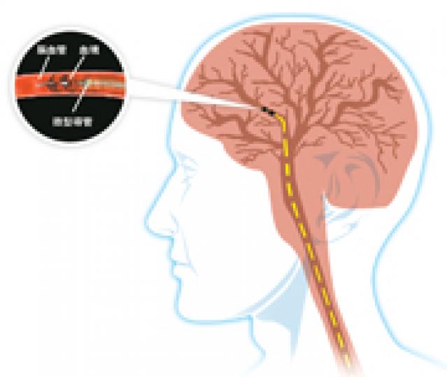 中風新療法以導管探入腦內,直接吸走血塊。(明報製圖) 神經外科專科醫生彭家雄(鄭寶華攝) 中風新療法以導管探入腦內,直接吸走血塊。(明報製圖) 神經外科專科醫生彭家雄(鄭寶華攝)