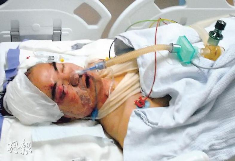 26歲姓林的寶馬司機,昨晨經約6小時手術後被送往深切治療部留醫,其面部傷痕纍纍。(雲錦鋒攝) 26歲姓林的寶馬司機,昨晨經約6小時手術後被送往深切治療部留醫,其面部傷痕纍纍。(雲錦鋒攝)