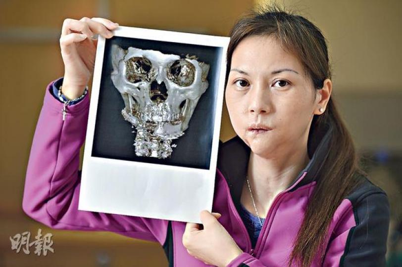 易小玲(圖)在人質事件中被子彈擊碎右邊下顎骨,之後的整形手術亦告失敗,她手持最近由韓國醫生幫她拍的X光片,可見其左下顎骨向右移,令面形扭曲,她希望可盡快到台灣接受整形手術防止病情惡化。(鄧宗弘攝) 易小玲(圖)在人質事件中被子彈擊碎右邊下顎骨,之後的整形手術亦告失敗,她手持最近由韓國醫生幫她拍的X光片,可見其左下顎骨向右移,令面形扭曲,她希望可盡快到台灣接受整形手術防止病情惡化。(鄧宗弘攝)