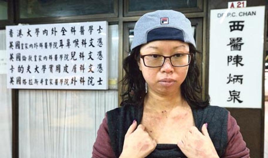 林小姐稱,上月向西醫陳炳泉求醫後出現藥物敏感,現時胸口仍有許多紅色疤痕,面部不斷甩皮,出門要戴頸巾、冷帽「包到實」。陳炳泉醫生的律師鄺偉全稱,林小姐向陳求診前,曾看過其他醫生、服用過其他藥物。(余俊亮攝)林小姐本月10日接受本報訪問時,其敏感徵狀已病發20日,手臂、雙腿、背脊等多個部位的皮膚有大量紅印,她擔心留下永久疤痕,以後夏天都要穿著長袖衫長褲。(余俊亮攝) 林小姐稱,上月向西醫陳炳泉求醫後出現藥物敏感,現時胸口仍有許多紅色疤痕,面部不斷甩皮,出門要戴頸巾、冷帽「包到實」。陳炳泉醫生的律師鄺偉全稱,林小姐向陳求診前,曾看過其他醫生、服用過其他藥物。(余俊亮攝)林小姐本月10日接受本報訪問時,其敏感徵狀已病發20日,手臂、雙腿、背脊等多個部位的皮膚有大量紅印,她擔心留下永久疤痕,以後夏天都要穿著長袖衫長褲。(余俊亮攝)