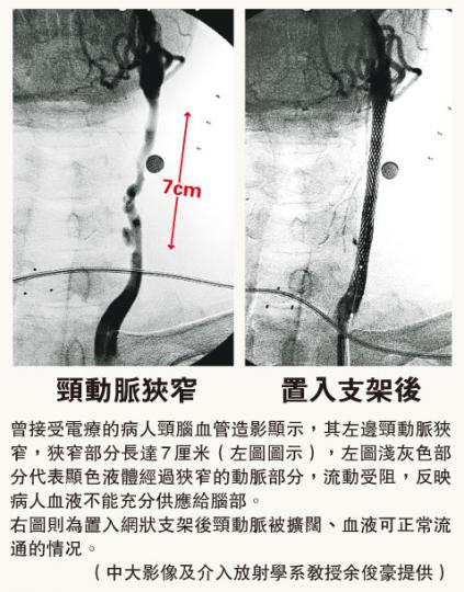 (明報製圖)50歲的鼻咽癌康復者朱先生受電療後10多年,左邊頸動脈血管完全閉塞,結果中風。他憶述當時任中港司機,開車過境途中失憶,其後半邊身癱瘓兩年。他接受支架置入手術後活動能力已恢復七成。(黃志東攝) (明報製圖)50歲的鼻咽癌康復者朱先生受電療後10多年,左邊頸動脈血管完全閉塞,結果中風。他憶述當時任中港司機,開車過境途中失憶,其後半邊身癱瘓兩年。他接受支架置入手術後活動能力已恢復七成。(黃志東攝)