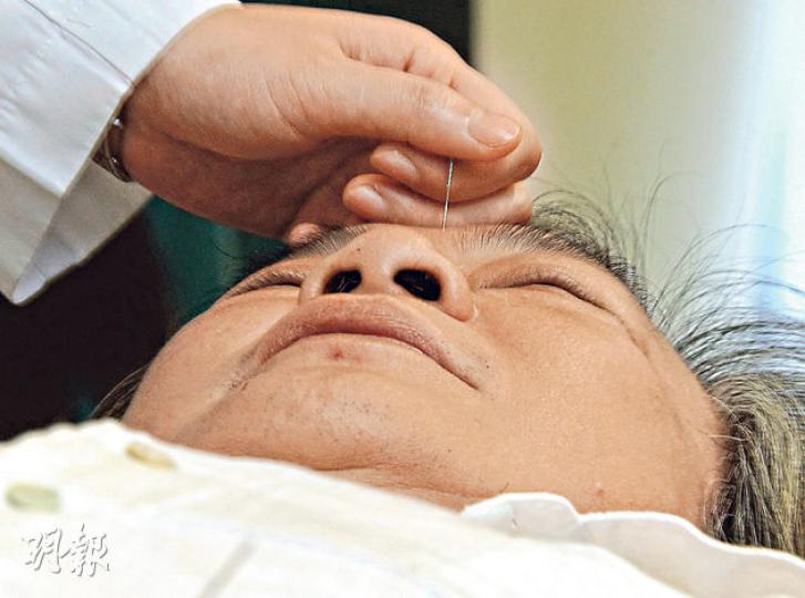 中醫針灸戒煙療程中,中醫師會於眉心的印堂穴施針,達至消除「退癮」症狀的效果。(李澤彤攝) 中醫針灸戒煙療程中,中醫師會於眉心的印堂穴施針,達至消除「退癮」症狀的效果。(李澤彤攝)