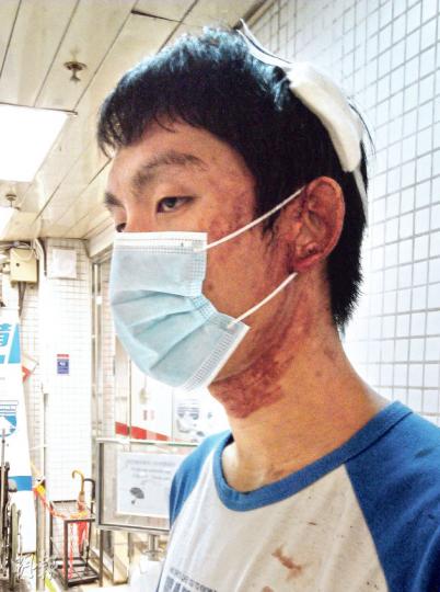 19歲嶺大學生程同學稱當時警方向油麻地方向推進,示威者不斷後退,但疑人太多、後退慢,警察揮動警棍,他被警棍擊中左後腦,頭破血流。(邱雅錡攝) 19歲嶺大學生程同學稱當時警方向油麻地方向推進,示威者不斷後退,但疑人太多、後退慢,警察揮動警棍,他被警棍擊中左後腦,頭破血流。(邱雅錡攝)