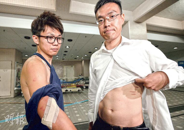 無綫記者昨晚採訪藍絲帶運動的活動時受襲,記者冼志(右)左肋骨部位有抓痕,攝影師雷釗河(左)上衣全被扯破,露出肩背,他的右手手踭亦受傷。(盧詡銘攝)港台記者王詠妍昨晚受襲後,到伊利沙伯醫院驗傷。她表示採訪時有人試圖搶其記者證及背包,並把她推跌,混亂中她被數名參加者踢中腰部,傷處紅腫,她的耳筒亦損毁。(盧翊銘攝)撐警大聯盟等多個團體昨晚於尖沙嘴鐘樓外集會支持警方執法,有逾千市民參加。集會人士舉起燭光和手機燈光,以及印有「愛香港、撐警察」的心形標語,以示支持警方執法(圖)。集會期間發生襲擊記者事件。( 無綫記者昨晚採訪藍絲帶運動的活動時受襲,記者冼志(右)左肋骨部位有抓痕,攝影師雷釗河(左)上衣全被扯破,露出肩背,他的右手手踭亦受傷。(盧詡銘攝)港台記者王詠妍昨晚受襲後,到伊利沙伯醫院驗傷。她表示採訪時有人試圖搶其記者證及背包,並把她推跌,混亂中她被數名參加者踢中腰部,傷處紅腫,她的耳筒亦損毁。(盧翊銘攝)撐警大聯盟等多個團體昨晚於尖沙嘴鐘樓外集會支持警方執法,有逾千市民參加。集會人士舉起燭光和手機燈光,以及印有「愛香港、撐警察」的心形標語,以示支持警方執法(圖)。集會期間發生襲擊記者事件。(