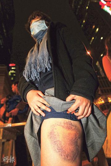 17歲中六生阿B(化名),昨戴着口罩掀起裙子向傳媒展示傷勢,左邊大腿大幅瘀傷。她指雖然被警棍打時很痛,但相信有更多人傷得更嚴重,希望佔領者要堅持,不要放棄。(郭慶輝攝)港大文學院二年級生黎的琛(圖)昨表示,周日在龍和道被警扯去頭盔,用警棍扑頭至血流披面(下圖),被帶返警署扣留3句鐘才獲送院,其間傷口不斷滲血。(郭慶輝攝) 17歲中六生阿B(化名),昨戴着口罩掀起裙子向傳媒展示傷勢,左邊大腿大幅瘀傷。她指雖然被警棍打時很痛,但相信有更多人傷得更嚴重,希望佔領者要堅持,不要放棄。(郭慶輝攝)港大文學院二年級生黎的琛(圖)昨表示,周日在龍和道被警扯去頭盔,用警棍扑頭至血流披面(下圖),被帶返警署扣留3句鐘才獲送院,其間傷口不斷滲血。(郭慶輝攝)