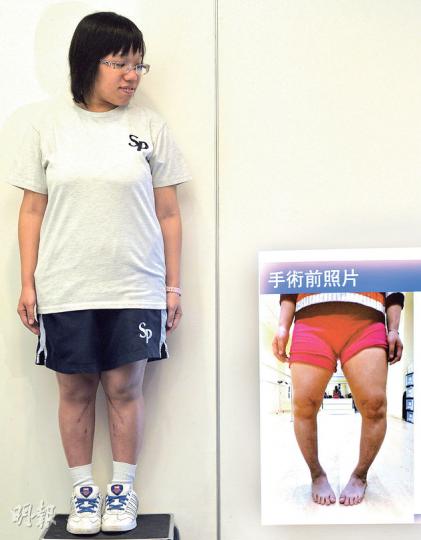 24歲的Ann自小患軟骨症,雙腳呈O形(右圖),去年3月接受新式下肢矯形手術後,雙腿已「變直」(左圖)。(余俊亮攝) 24歲的Ann自小患軟骨症,雙腳呈O形(右圖),去年3月接受新式下肢矯形手術後,雙腿已「變直」(左圖)。(余俊亮攝)
