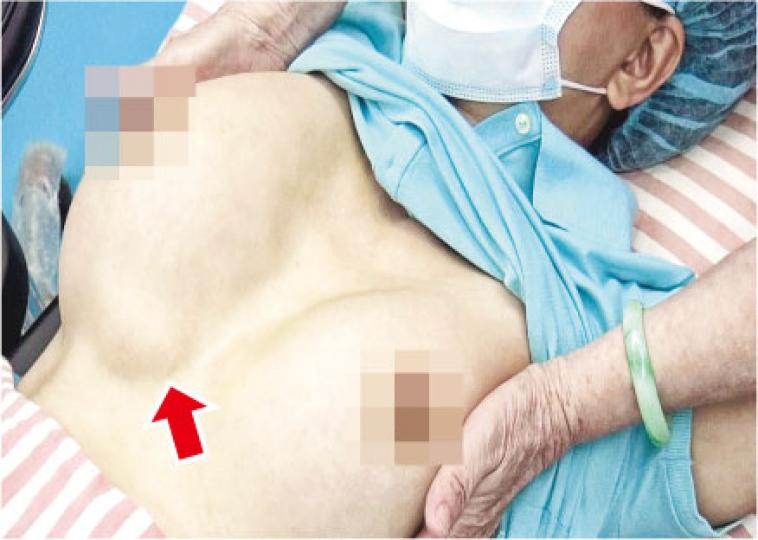 李小姐(化名)10多年前接受注射式隆胸,兩邊乳房各注入250毫升奧美定。李醫生用手將李小姐的雙乳擠壓,可見右邊乳房明顯畸形,底部(箭嘴示)有一手掌大小的部分隆起。(蔡傳威攝)李如英醫生(圖)指出,已植入的PAAG難以完全清除。(林俊源攝) 李小姐(化名)10多年前接受注射式隆胸,兩邊乳房各注入250毫升奧美定。李醫生用手將李小姐的雙乳擠壓,可見右邊乳房明顯畸形,底部(箭嘴示)有一手掌大小的部分隆起。(蔡傳威攝)李如英醫生(圖)指出,已植入的PAAG難以完全清除。(林俊源攝)