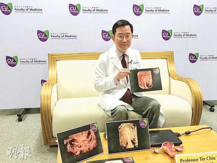 中大婦產科學系去年7月起設立慣性流產門診,並引入3維超聲波技術檢測孕婦子宮結構,該系教授李天照稱,正常的子宮(手持圖片)可容納胎兒日漸成長,有異常的子宮則會內壁膜黏連或內壁過窄(枱上圖片),易致流產。(梁杏怡攝) 中大婦產科學系去年7月起設立慣性流產門診,並引入3維超聲波技術檢測孕婦子宮結構,該系教授李天照稱,正常的子宮(手持圖片)可容納胎兒日漸成長,有異常的子宮則會內壁膜黏連或內壁過窄(枱上圖片),易致流產。(梁杏怡攝)