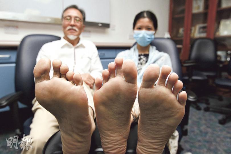 退休者鄧先生(左)的左腳及30多歲鄭小姐(右)的雙腳均曾拇趾外翻,接受「內窺鏡輔助拇趾外翻手術」矯正後,拇趾角度變正常,痛楚亦減。(郭慶輝攝) 退休者鄧先生(左)的左腳及30多歲鄭小姐(右)的雙腳均曾拇趾外翻,接受「內窺鏡輔助拇趾外翻手術」矯正後,拇趾角度變正常,痛楚亦減。(郭慶輝攝)