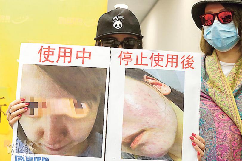 陳小姐(化名,左)及李小姐(化名,右)分別使用「水X肌」水光針約7個月及9個月,她們都說使用期間「面色紅潤光滑」,但甫停用即現紅疹,嘴角甚至現膿瘡。圖為陳小姐展示她使用水光針期間及停用後的臉部皮膚情况。(李紹昌攝) 陳小姐(化名,左)及李小姐(化名,右)分別使用「水X肌」水光針約7個月及9個月,她們都說使用期間「面色紅潤光滑」,但甫停用即現紅疹,嘴角甚至現膿瘡。圖為陳小姐展示她使用水光針期間及停用後的臉部皮膚情况。(李紹昌攝)