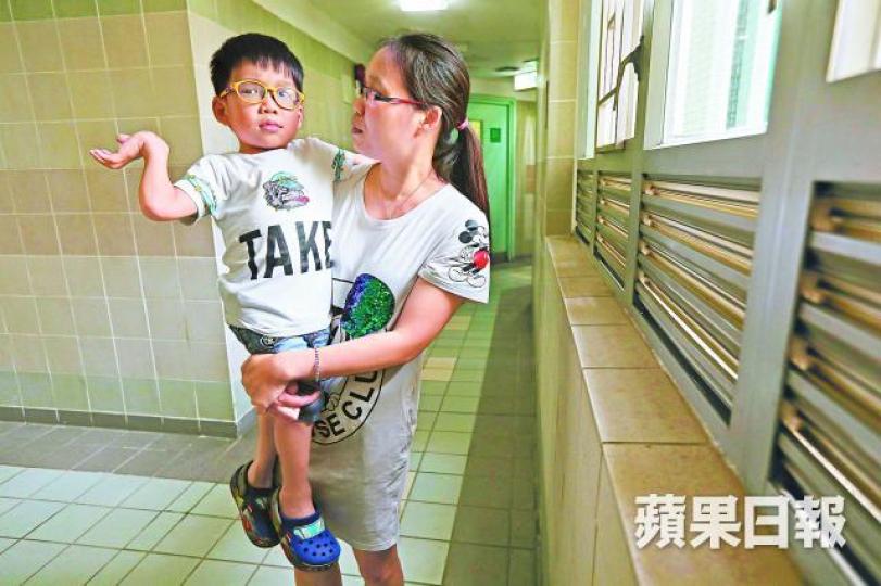 ■曉進前年曾做「後顱窩減壓及枕頸椎融合」手術,留下6吋長疤痕。
■曉進前年曾做「後顱窩減壓及枕頸椎融合」手術,留下6吋長疤痕。