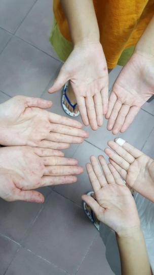 ■曾有一家五口感染手足口病,圖為其中三人出水泡情況。林永和提供圖片 ■曾有一家五口感染手足口病,圖為其中三人出水泡情況。林永和提供圖片