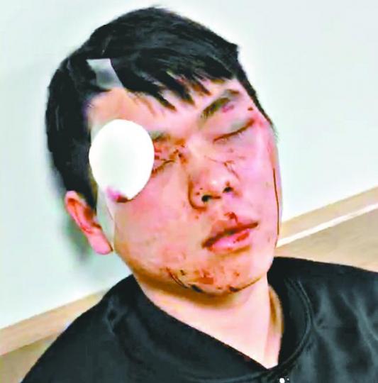■中國留學生眼、頭部被打傷。■女生被毆後腿部留下瘀傷。 ■中國留學生眼、頭部被打傷。■女生被毆後腿部留下瘀傷。