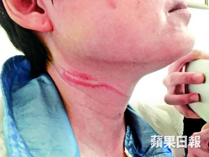 ■脫北婦遭人勒頸後留下兩條紅印。翁鈺輝攝■在寓所梯間遇襲的脫北婦前晚送院。姜偉康攝■警方在現場帶走一名男子協助調查。■金婦(左)前年因患癌騙公司津貼治病,當時需要撐枴杖上庭。資料圖片 ■脫北婦遭人勒頸後留下兩條紅印。翁鈺輝攝■在寓所梯間遇襲的脫北婦前晚送院。姜偉康攝■警方在現場帶走一名男子協助調查。■金婦(左)前年因患癌騙公司津貼治病,當時需要撐枴杖上庭。資料圖片