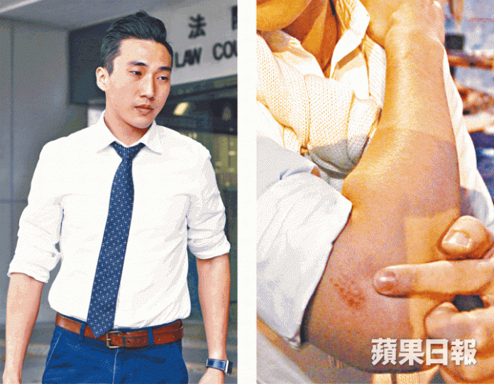 ■鄭仲恒昨出庭覆述被打經過,當日除後頸中棍外,手肘(右圖)也有受傷。 ■鄭仲恒昨出庭覆述被打經過,當日除後頸中棍外,手肘(右圖)也有受傷。