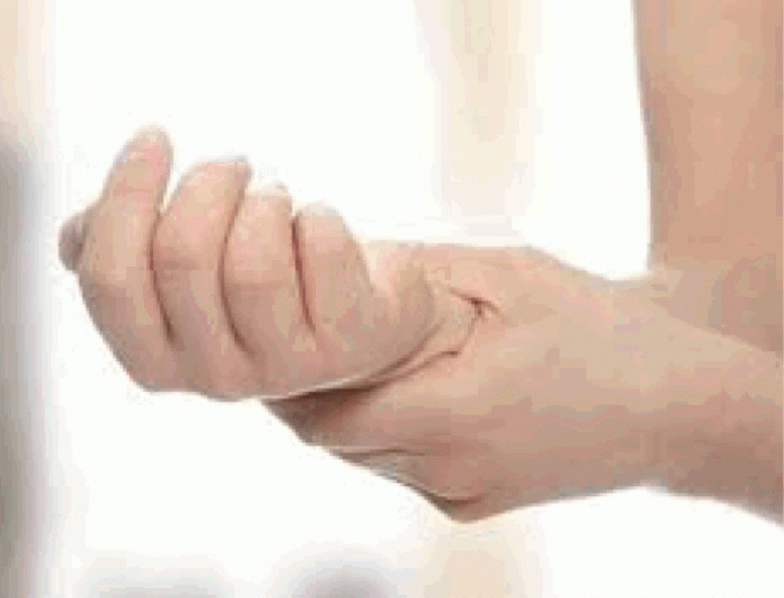 ■腱鞘囊腫常出現在手腕位置。 ■腱鞘囊腫常出現在手腕位置。