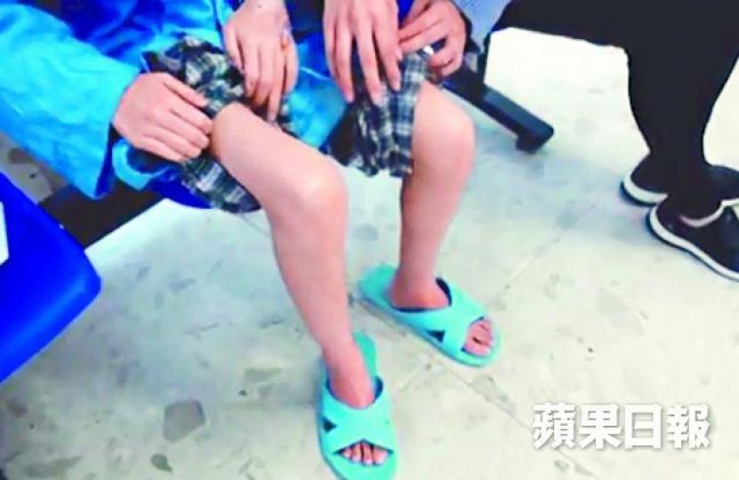 ■月盈雙腿瘦弱,身體就似玻璃一樣,稍有碰撞就會受傷。 ■月盈雙腿瘦弱,身體就似玻璃一樣,稍有碰撞就會受傷。