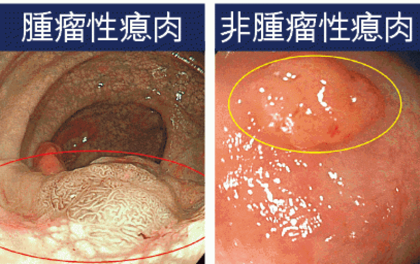 ■絨毛腺瘤(左)屬腫瘤性瘜肉,較增生性瘜肉(右)有更高的變癌風險。 ■絨毛腺瘤(左)屬腫瘤性瘜肉,較增生性瘜肉(右)有更高的變癌風險。