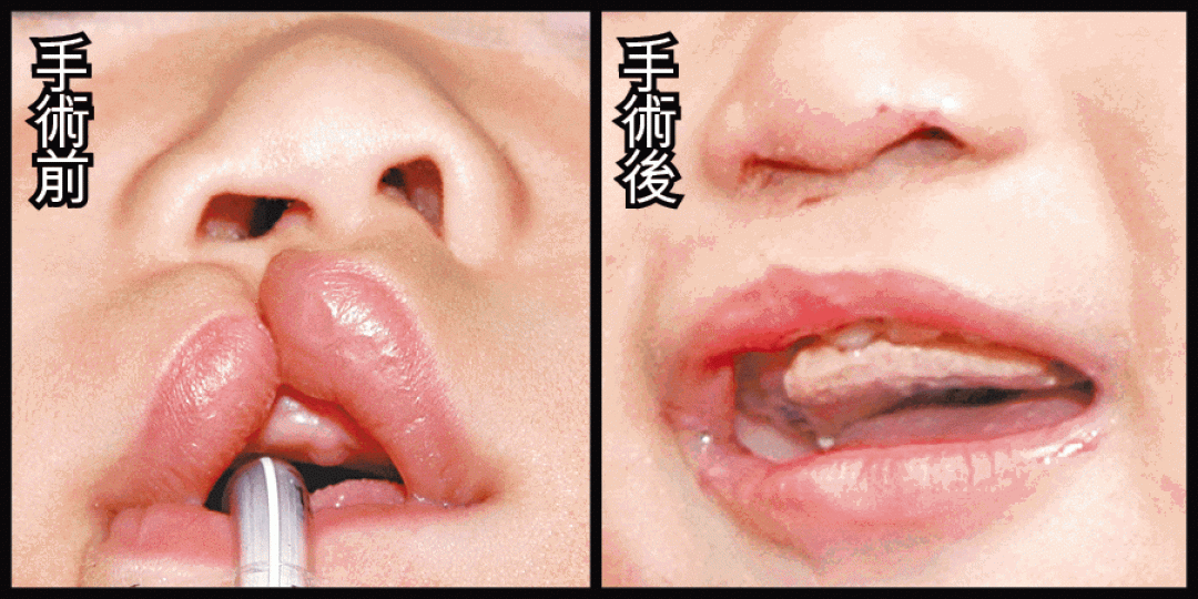 ■幼嬰3個月大時可接受縫唇手術。 ■幼嬰3個月大時可接受縫唇手術。