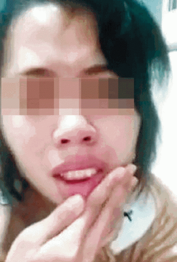 ■疑被掌摑及叉頸女傭對鏡頭展示嘴部傷勢。互聯網 ■疑被掌摑及叉頸女傭對鏡頭展示嘴部傷勢。互聯網