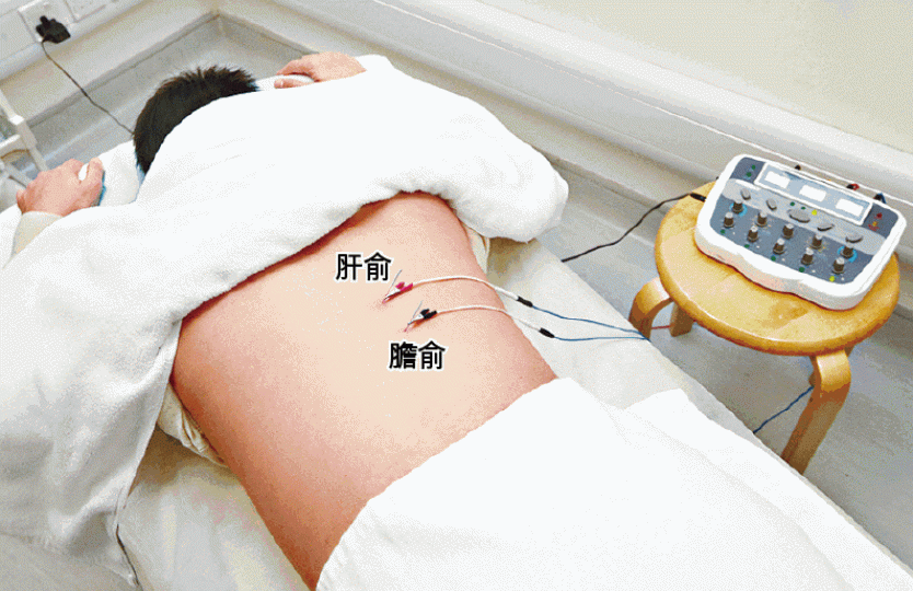 ■中大中醫學院研究以電針灸穴位,包括肝俞及膽俞,助病人排走膽石。黎樹雄攝 ■中大中醫學院研究以電針灸穴位,包括肝俞及膽俞,助病人排走膽石。黎樹雄攝