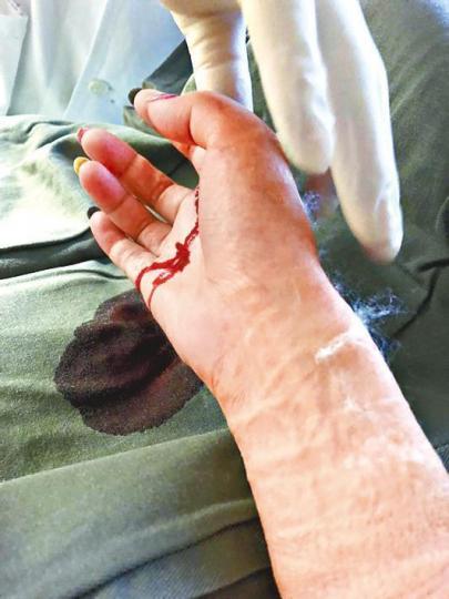 ■港女稱阻狗狗打架期間被咬傷手。 ■港女稱阻狗狗打架期間被咬傷手。