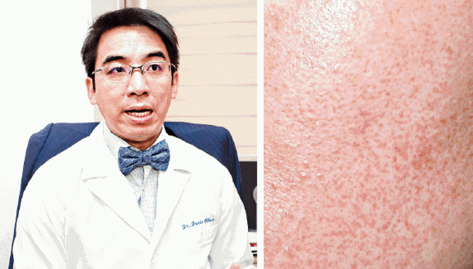 ■醫生陳湧指有男病人因誤用果酸產品致皮膚過敏變紅(右圖)。 ■醫生陳湧指有男病人因誤用果酸產品致皮膚過敏變紅(右圖)。