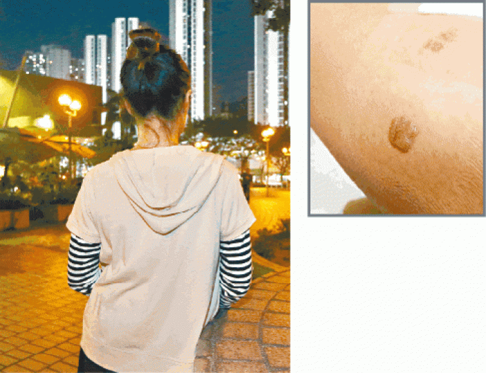 ■區小姐在Dream Beauty Pro脫毛時被燒傷,小腿留下兩個傷口(右圖)。王子俊攝
■區小姐在Dream Beauty Pro脫毛時被燒傷,小腿留下兩個傷口(右圖)。王子俊攝